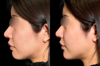 あご先リフト＋ボトックス（顎）