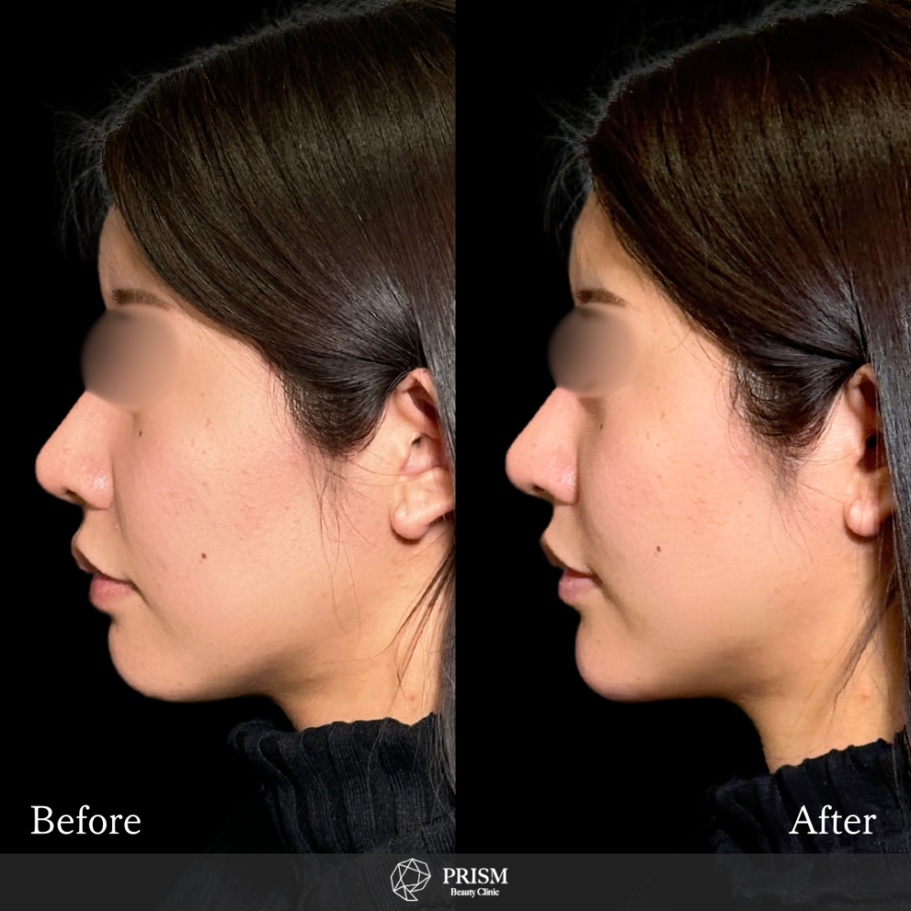 あご先リフト+ボトックス(顎) あご先リフト+ボトックス(顎)