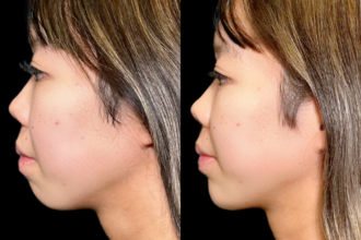 あご先リフト＋ ヒアルロン酸（顎）