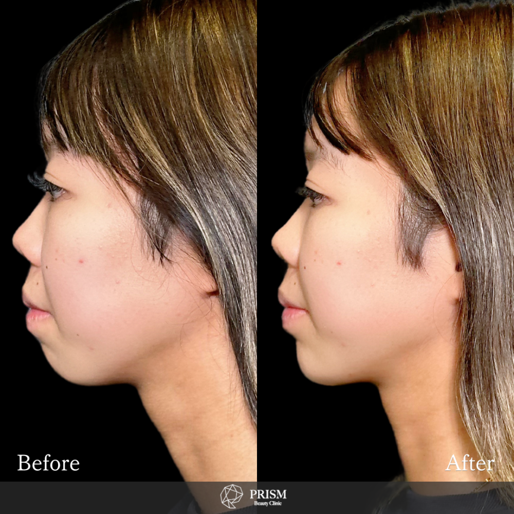 あご先リフト+ ヒアルロン酸(顎) あご先リフト+ ヒアルロン酸(顎)