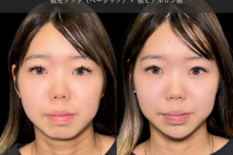 あご先リフト＋ ヒアルロン酸（顎）