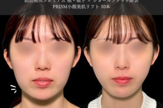 脂肪吸引プレミアム（頬・顎下）＋ジョールファット除去＋糸リフト（ウルトラソフト）