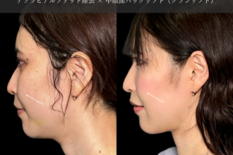 ナゾラビアルファット除去 +中顔面バックリフト( 糸リフト) ナゾラビアルファット除去 +中顔面バックリフト( 糸リフト)