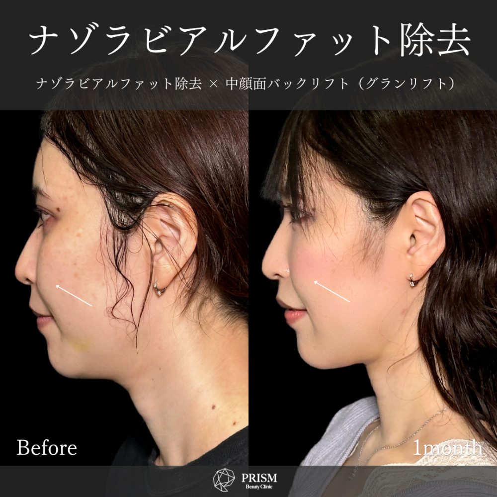 ナゾラビアルファット除去 +中顔面バックリフト( 糸リフト) ナゾラビアルファット除去 +中顔面バックリフト( 糸リフト)