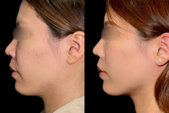 ナゾラビアルファット除去 +中顔面バックリフト( 糸リフト) ナゾラビアルファット除去 +中顔面バックリフト( 糸リフト)