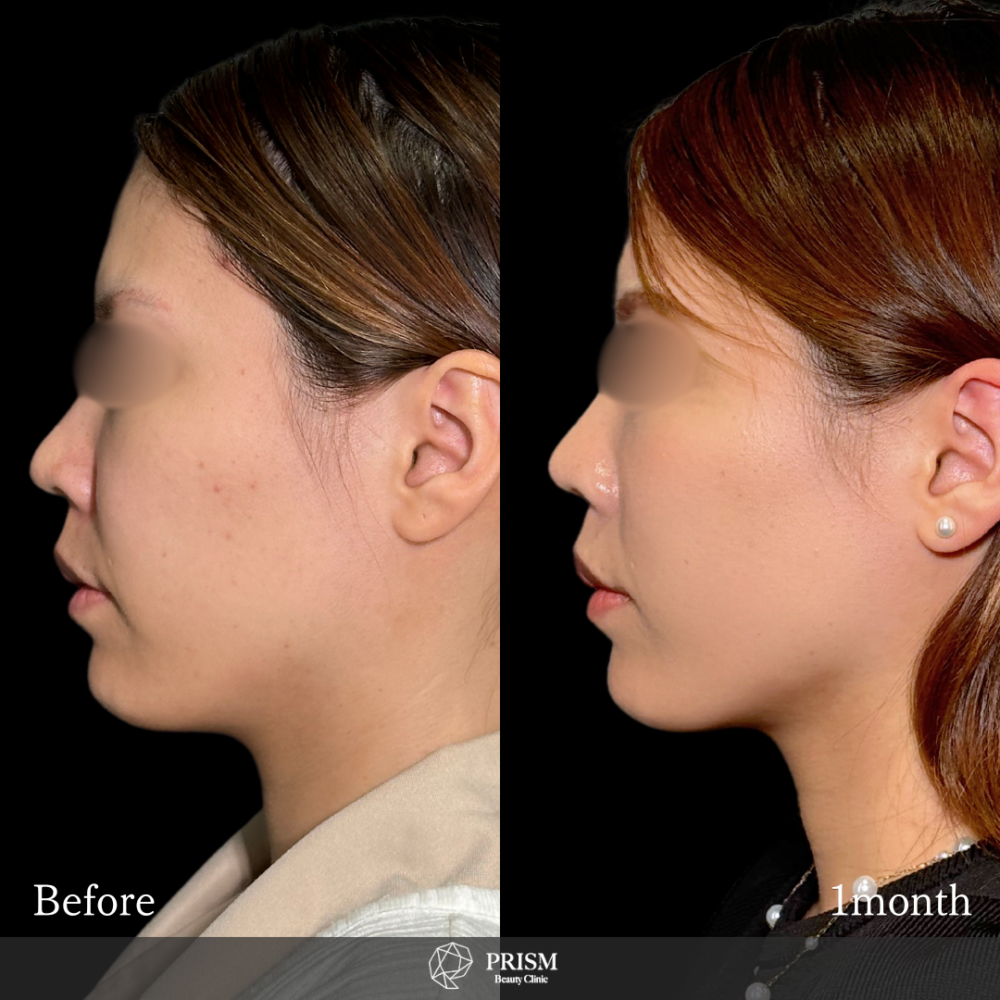 ナゾラビアルファット除去 +中顔面バックリフト( 糸リフト) ナゾラビアルファット除去 +中顔面バックリフト( 糸リフト)