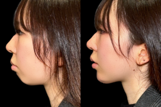 あご先リフト＋ ヒアルロン酸注射（顎）＋ボトックス注射（顎）