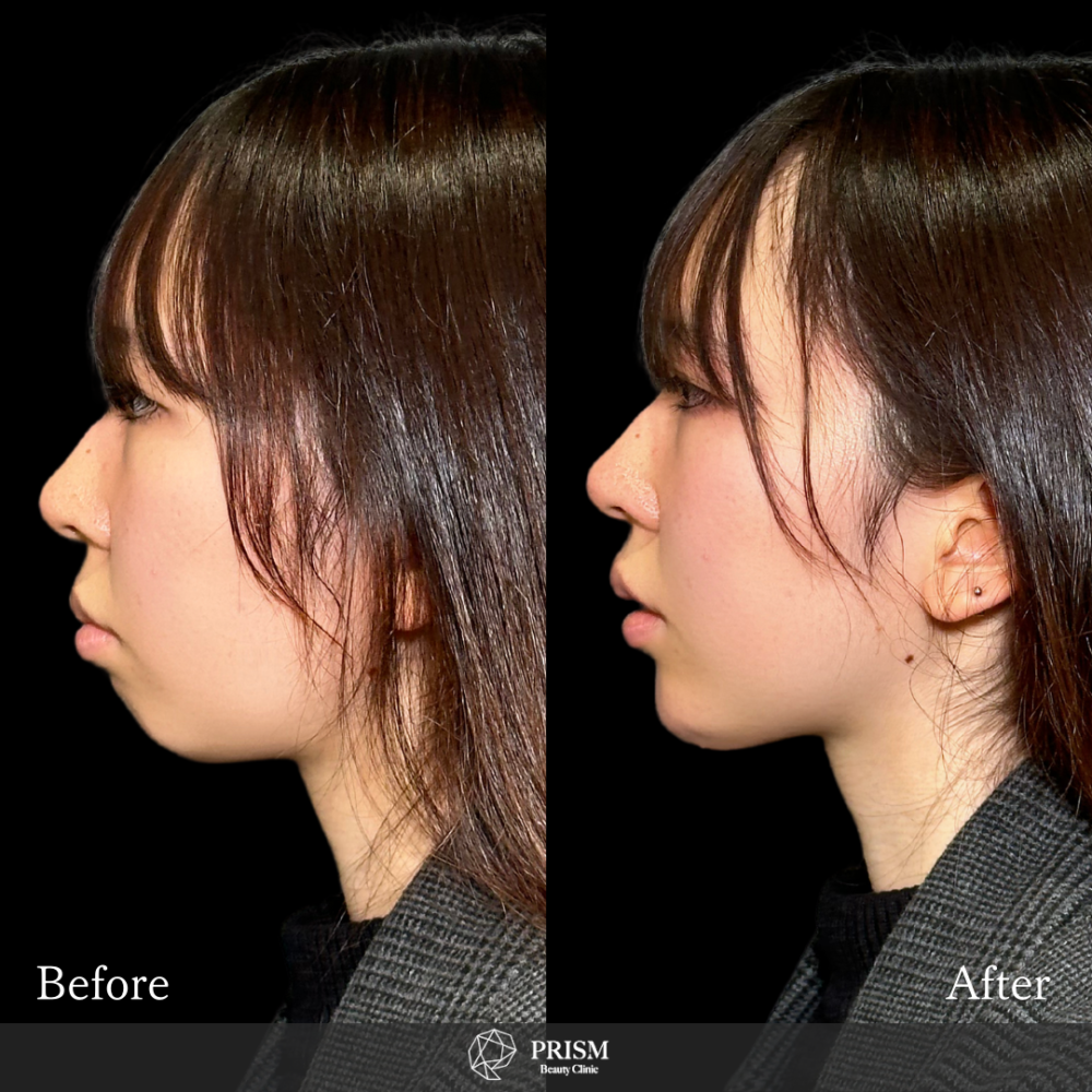 あご先リフト+ ヒアルロン酸注射(顎)+ボトックス注射(顎) あご先リフト+ ヒアルロン酸注射(顎)+ボトックス注射(顎)