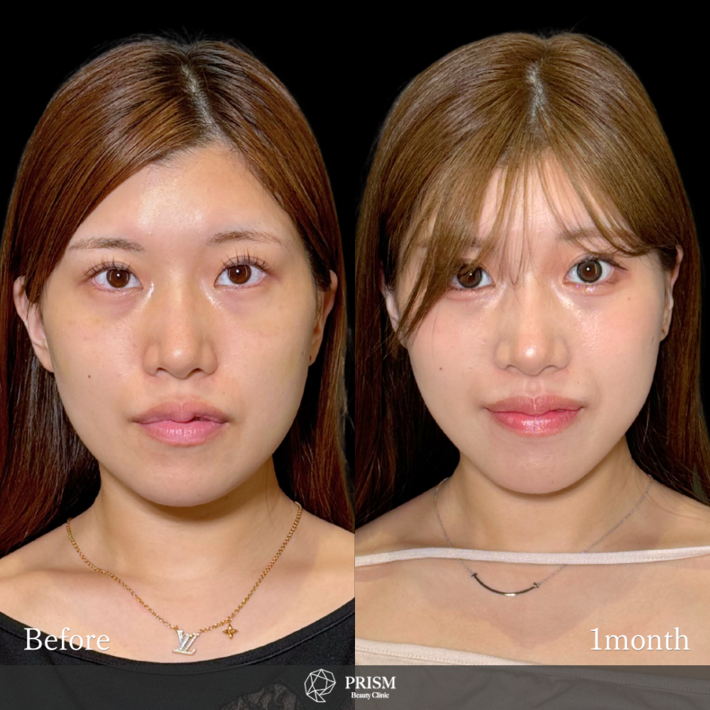 脂肪吸引クイック(頬・あご下)+糸リフト 脂肪吸引クイック(頬・あご下)+糸リフト