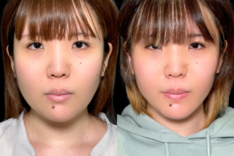 脂肪吸引クイック（頬・顎下） ＋ エラボトックス