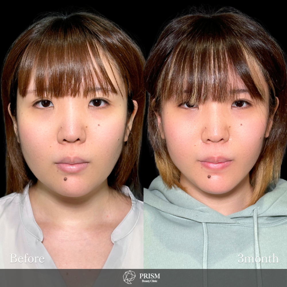 脂肪吸引クイック(頬・顎下) + エラボトックス 脂肪吸引クイック(頬・顎下) + エラボトックス