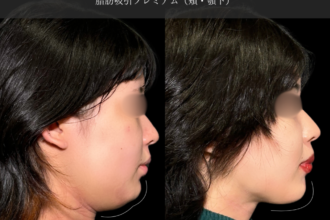 脂肪吸引プレミアム(頬・顎下) 脂肪吸引プレミアム(頬・顎下)