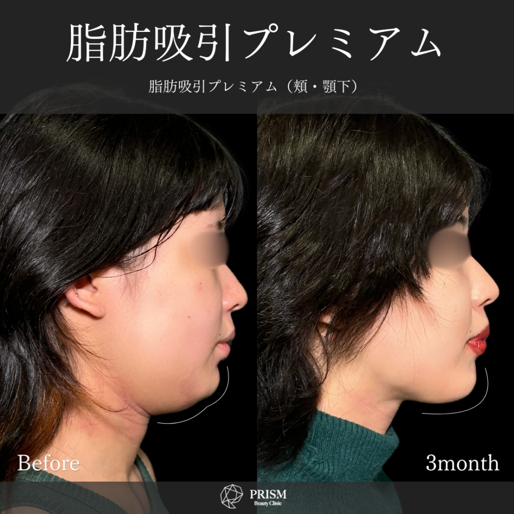 脂肪吸引プレミアム（頬・顎下）