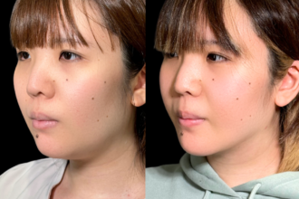 脂肪吸引クイック（頬・顎下） ＋ エラボトックス