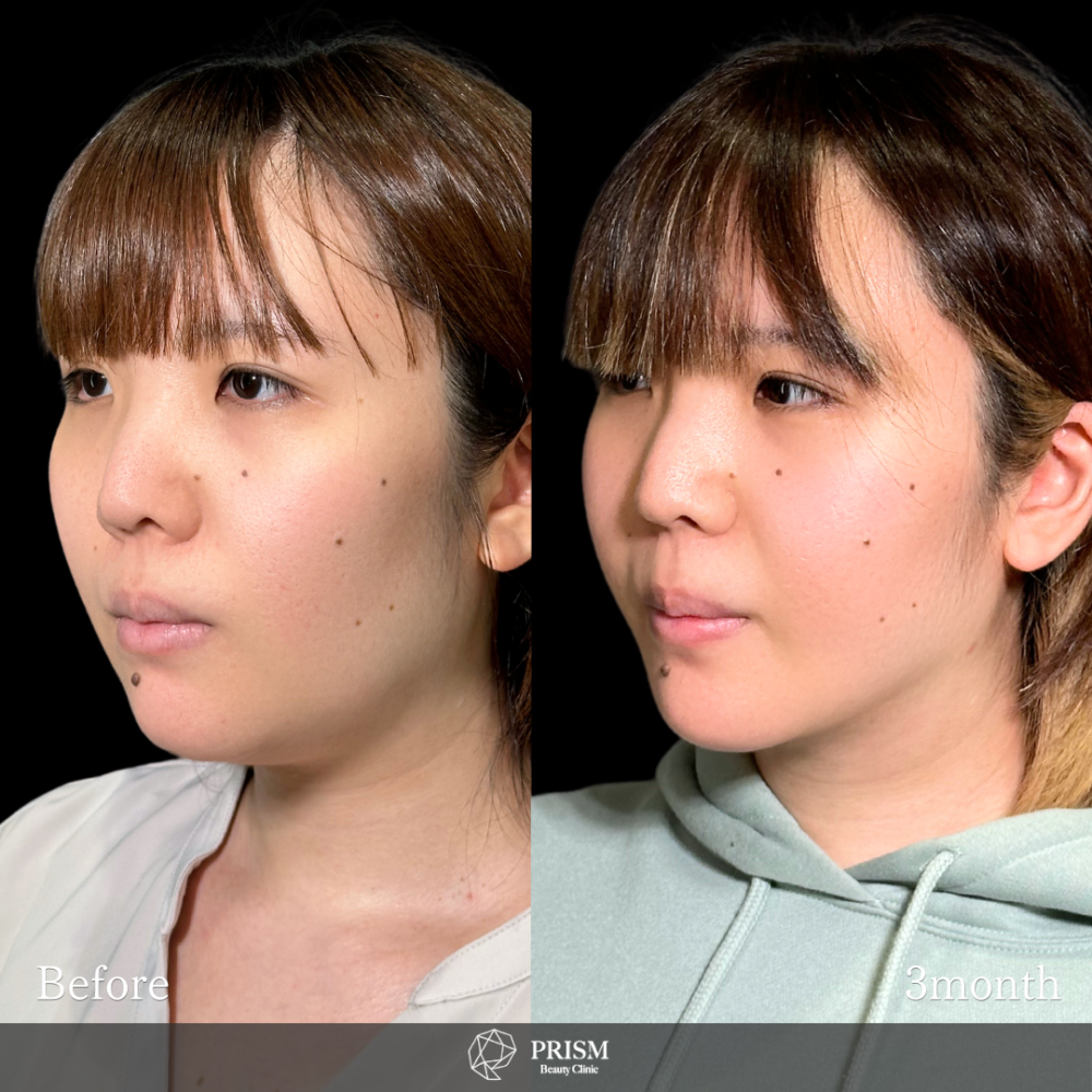 脂肪吸引クイック(頬・顎下) + エラボトックス 脂肪吸引クイック(頬・顎下) + エラボトックス