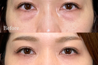 切らない目の下のクマ取り+ヒアルロン酸(目の下) 切らない目の下のクマ取り+ヒアルロン酸(目の下)