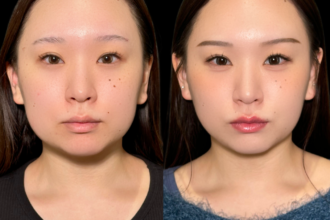 脂肪吸引クイック(頬・顎下)+バッカルファット除去 脂肪吸引クイック(頬・顎下)+バッカルファット除去