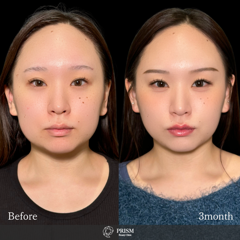 脂肪吸引クイック(頬・顎下)+バッカルファット除去 脂肪吸引クイック(頬・顎下)+バッカルファット除去