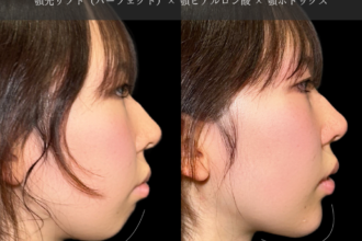 あご先リフト＋ ヒアルロン酸注射（顎）＋ボトックス注射（顎）