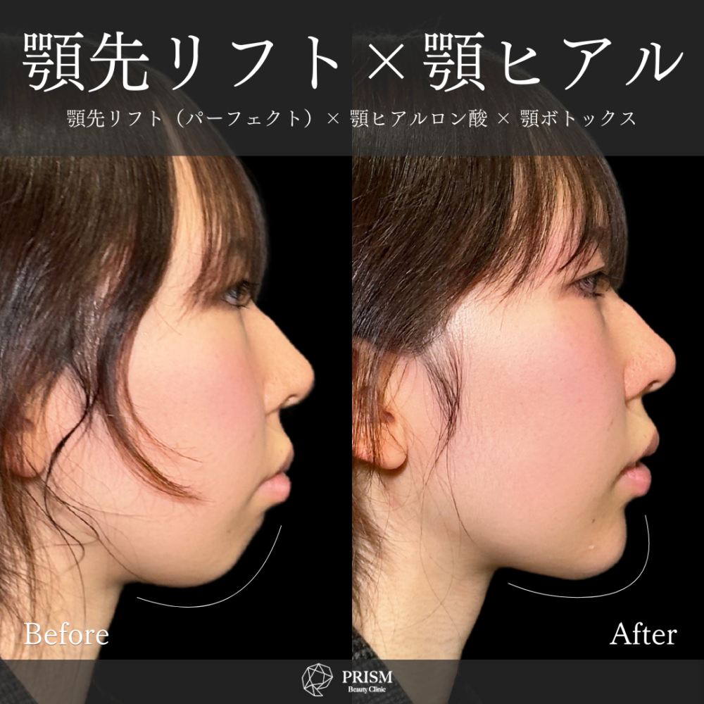 ヒアルロン酸注射 < 新宿・町田の美容外科・美容皮膚科｜PRISM Beauty