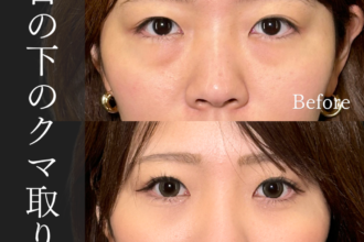 切らない目の下のクマ取り＋ヒアルロン酸（目の下）