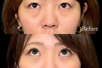 切らない目の下のクマ取り＋ヒアルロン酸（目の下）