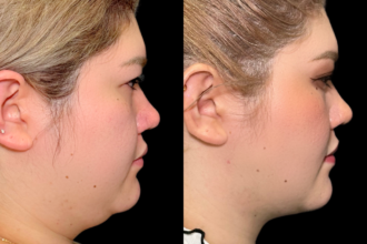 脂肪吸引クイック（頬・顎下）＋糸リフト＋バッカルファット除去＋ボトックス注射（エラ）