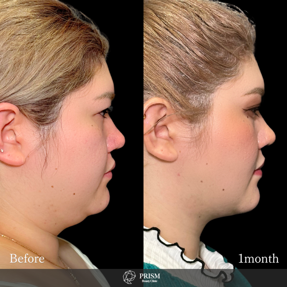 脂肪吸引クイック(頬・顎下)+糸リフト+バッカルファット除去+ボトックス注射(エラ) 脂肪吸引クイック(頬・顎下)+糸リフト+バッカルファット除去+ボトックス注射(エラ)