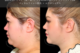 脂肪吸引クイック（頬・顎下）＋糸リフト＋バッカルファット除去＋ボトックス注射（エラ）