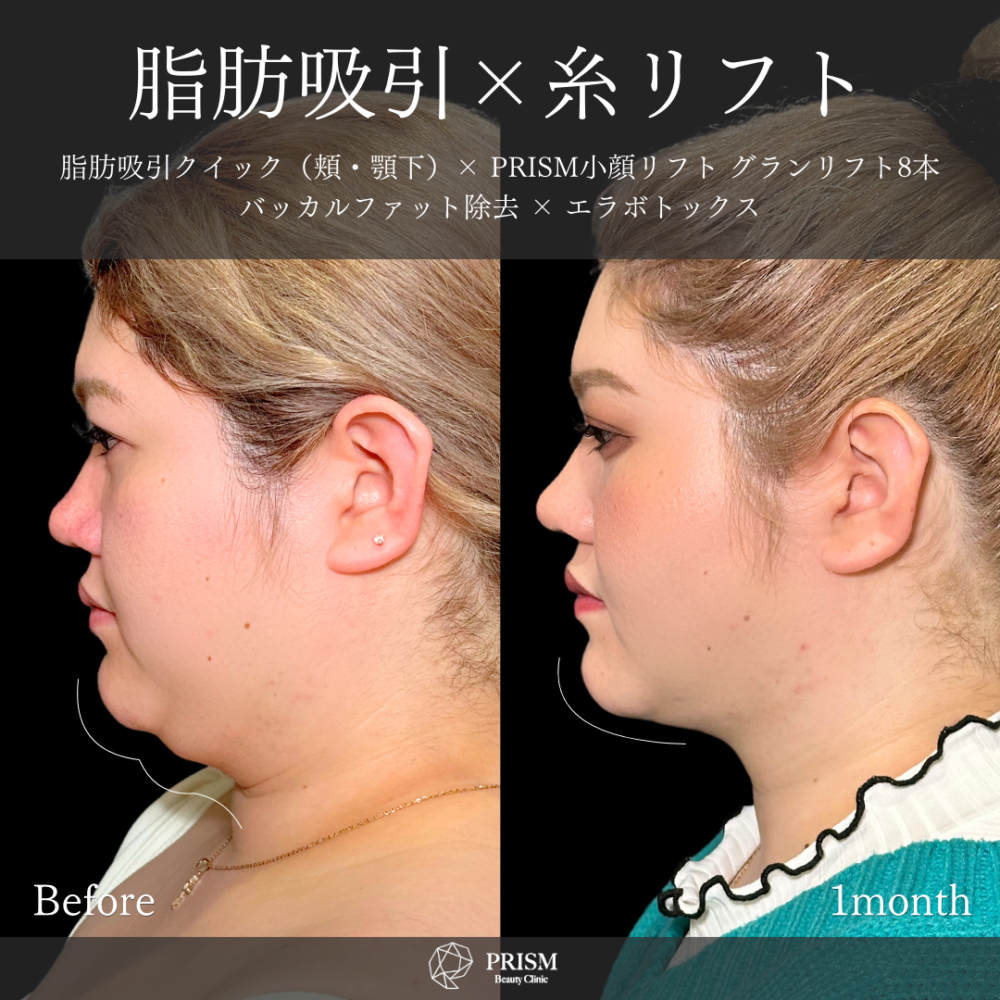 脂肪吸引クイック(頬・顎下)+糸リフト+バッカルファット除去+ボトックス注射(エラ) 脂肪吸引クイック(頬・顎下)+糸リフト+バッカルファット除去+ボトックス注射(エラ)