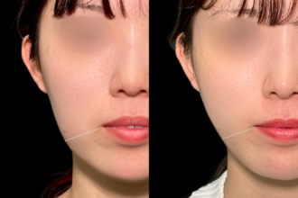 脂肪吸引プレミアム（頬・顎下）＋ジョールファット除去＋糸リフト（ウルトラソフト）