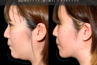 脂肪吸引クイック（頬・顎下） ＋ エラボトックス