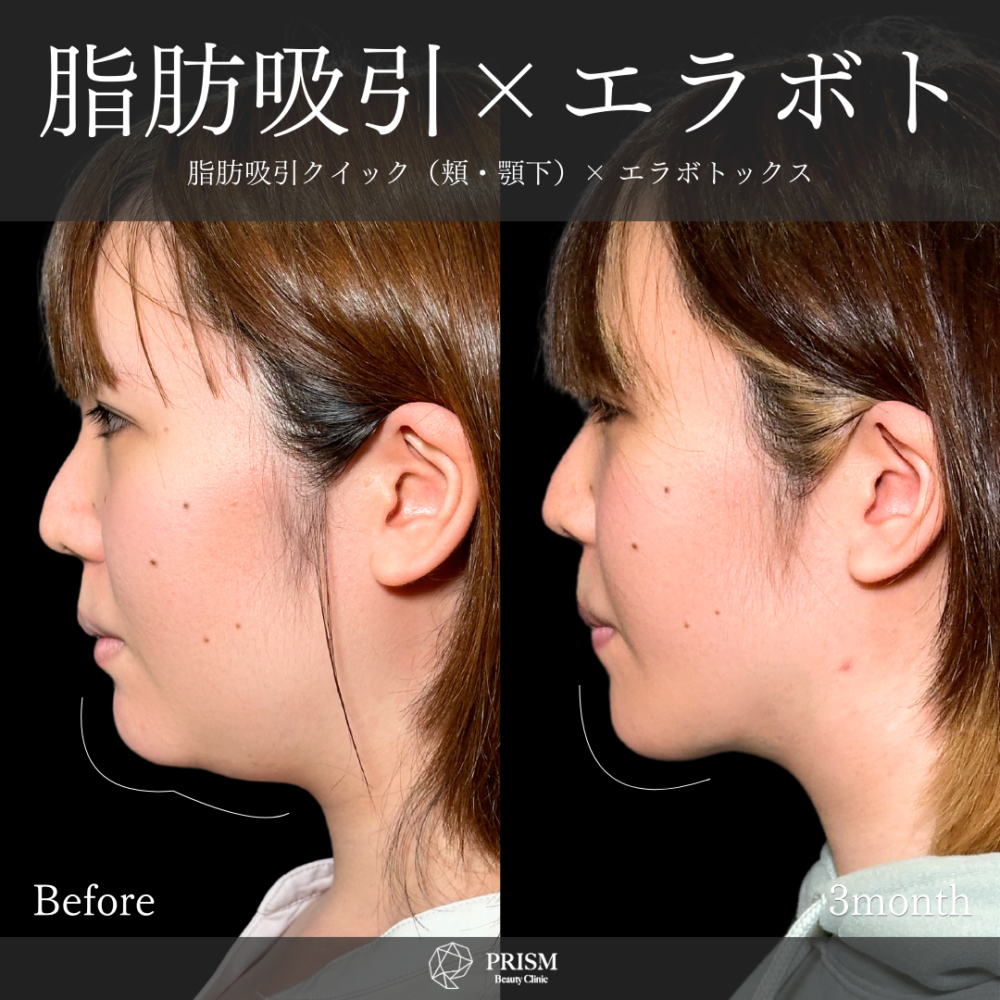 脂肪吸引クイック(頬・顎下) + エラボトックス 脂肪吸引クイック(頬・顎下) + エラボトックス