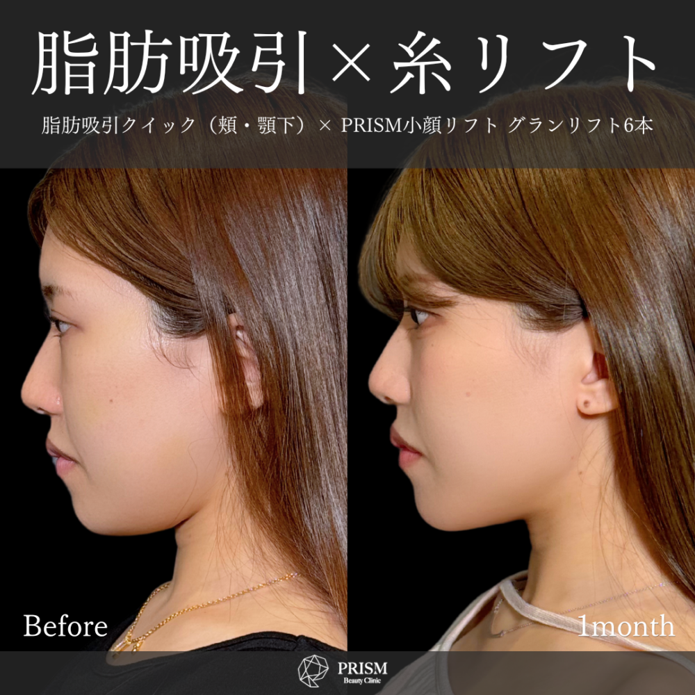 脂肪吸引クイック(頬・あご下)+糸リフト 脂肪吸引クイック(頬・あご下)+糸リフト