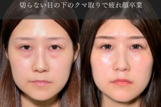 切らない目の下のクマ取り（経結膜脱脂術）