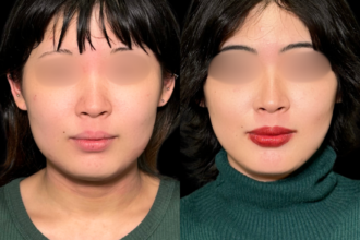 脂肪吸引プレミアム(頬・顎下) 脂肪吸引プレミアム(頬・顎下)