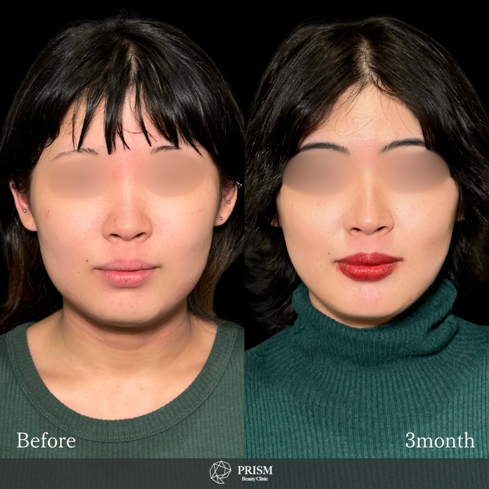 脂肪吸引プレミアム（頬・顎下）