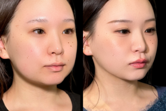 脂肪吸引クイック(頬・顎下)+バッカルファット除去 脂肪吸引クイック(頬・顎下)+バッカルファット除去