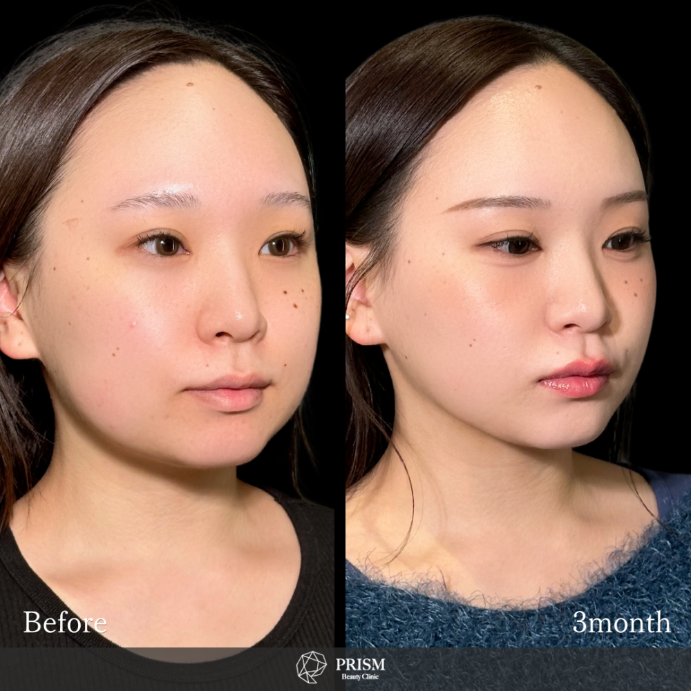 脂肪吸引クイック(頬・顎下)+バッカルファット除去 脂肪吸引クイック(頬・顎下)+バッカルファット除去