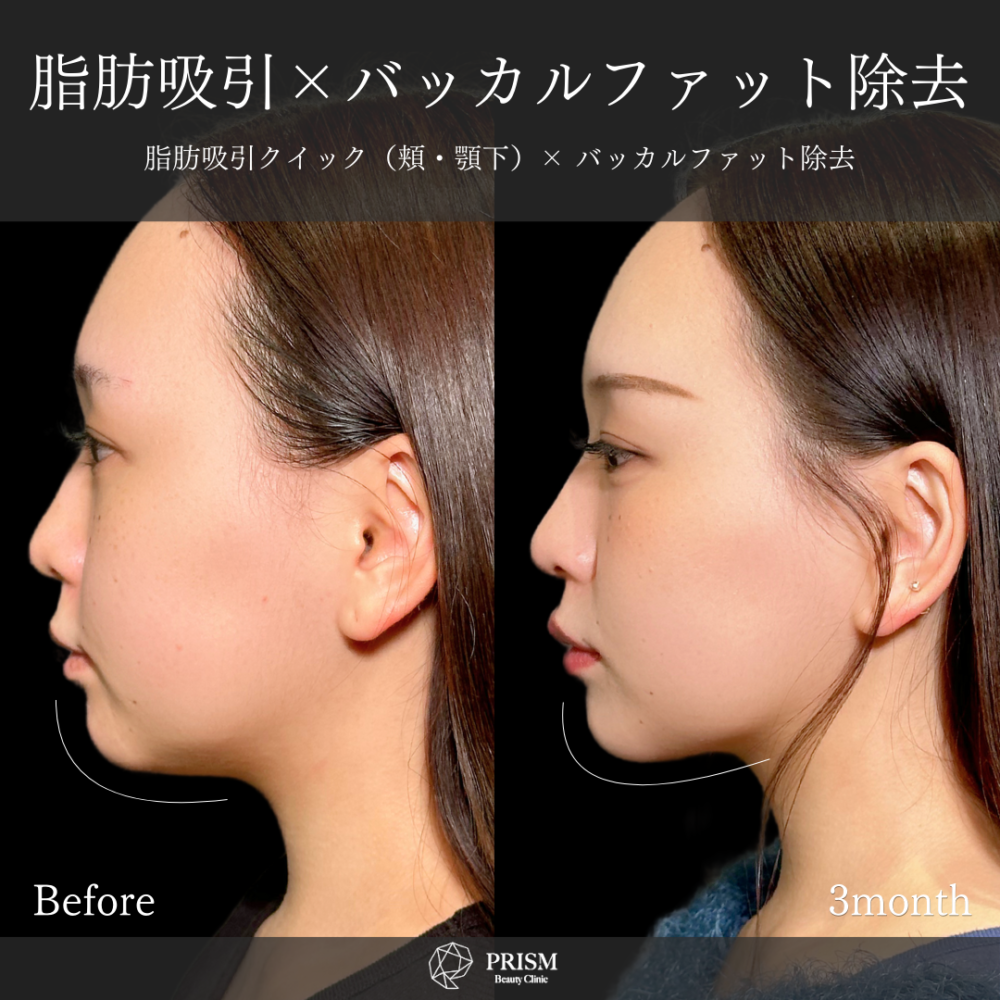 脂肪吸引クイック(頬・顎下)+バッカルファット除去 脂肪吸引クイック(頬・顎下)+バッカルファット除去