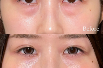 切らない目の下のクマ取り（経結膜脱脂術）