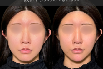 あご先リフト＋ボトックス（顎）