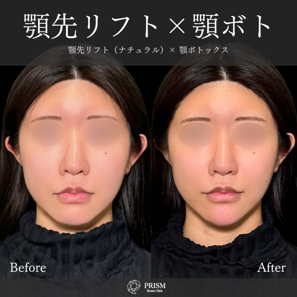 あご先リフト+ボトックス(顎) あご先リフト+ボトックス(顎)