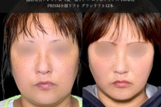 脂肪吸引プレミアム（頬・顎下）＋糸リフト（グランリフト）＋エラボトックス