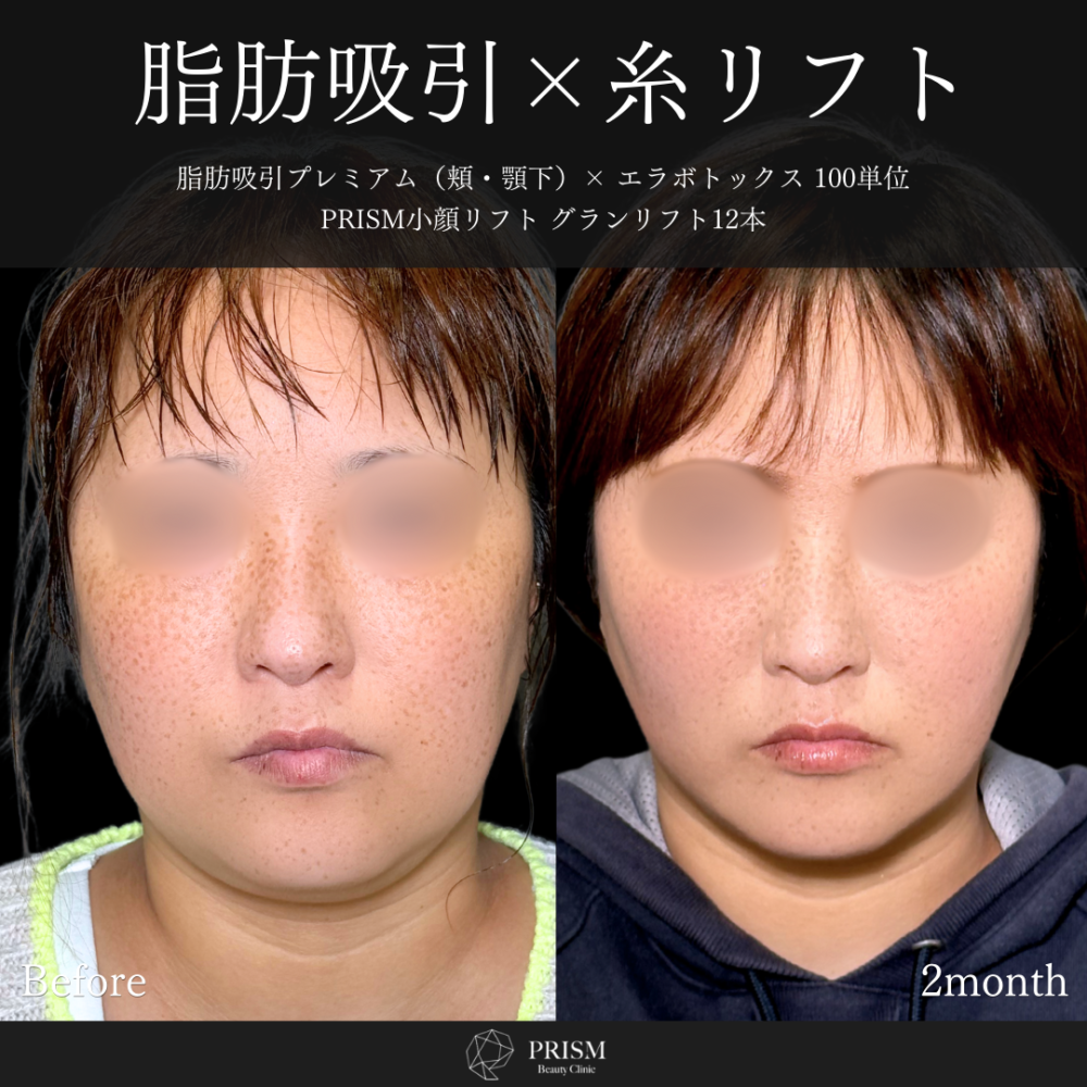 脂肪吸引プレミアム(頬・顎下)+糸リフト(グランリフト)+エラボトックス 脂肪吸引プレミアム(頬・顎下)+糸リフト(グランリフト)+エラボトックス