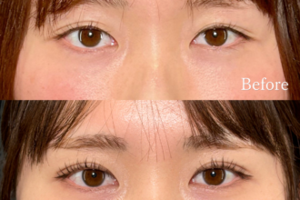 PRISM 1day二重埋没 シークレットダブル 線留め (自然癒着法)