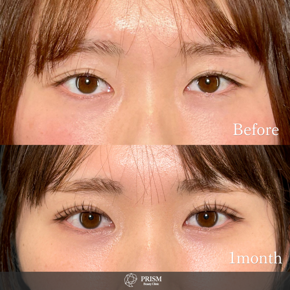 PRISM 1day二重埋没 シークレットダブル 線留め (自然癒着法) PRISM 1day二重埋没 シークレットダブル 線留め (自然癒着法)