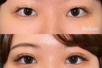 PRISM 1day二重埋没 プレミアム 線留め (自然癒着法)