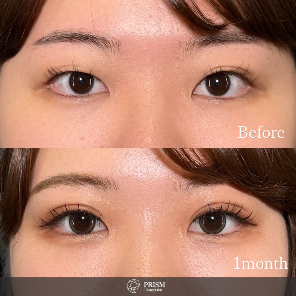 PRISM 1day二重埋没 プレミアム 線留め (自然癒着法) PRISM 1day二重埋没 プレミアム 線留め (自然癒着法)