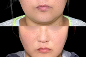 脂肪吸引プレミアム（頬・顎下）＋糸リフト（グランリフト）＋エラボトックス